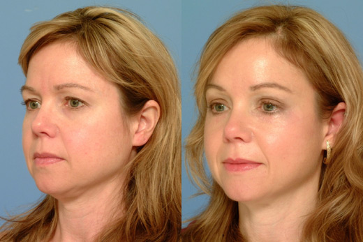 brow lift